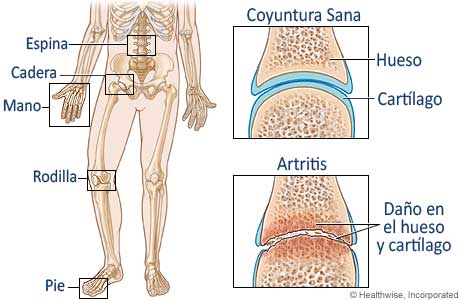 Las causas de la artritis