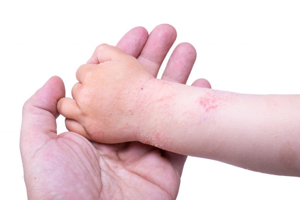 Dermatitis de contacto en niños 
